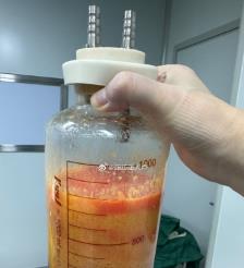 晋城水动力吸脂手术要做多久？